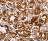 Immunohistochemistry of paraffin-embedded Human thyroid cancer tissue using ATRN Polyclonal Antibody at dilution 1:50