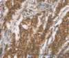 Immunohistochemistry of paraffin-embedded Human gastic cancer using BCAS4 Polyclonal Antibody at dilution of 1:50