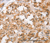 Immunohistochemistry of paraffin-embedded Human thyroid cancer using BCAS4 Polyclonal Antibody at dilution of 1:50