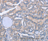 Immunohistochemistry of paraffin-embedded Human thyroid cancer tissue using BOD1 Polyclonal Antibody at dilution 1:60