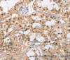 Immunohistochemistry of paraffin-embedded Human thyroid cancer tissue using Cav1.3 Polyclonal Antibody at dilution 1:40