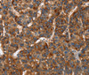 Immunohistochemistry of paraffin-embedded Human liver cancer tissue using CACNB2 Polyclonal Antibody at dilution 1:30