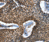Immunohistochemistry of paraffin-embedded Human lung cancer tissue using CACNB2 Polyclonal Antibody at dilution 1:30