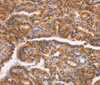 Immunohistochemistry of paraffin-embedded Human thyroid cancer tissue using NCAPG2 Polyclonal Antibody at dilution 1:50