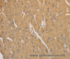 Immunohistochemistry of paraffin-embedded Human liver cancer tissue using CD40 Polyclonal Antibody at dilution 1:70