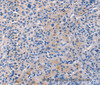 Immunohistochemistry of paraffin-embedded Human liver cancer tissue using CD5L Polyclonal Antibody at dilution 1:40