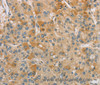 Immunohistochemistry of paraffin-embedded Human liver cancer tissue using CENPF Polyclonal Antibody at dilution 1:40