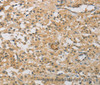 Immunohistochemistry of paraffin-embedded Human thyroid cancer tissue using CENPF Polyclonal Antibody at dilution 1:40