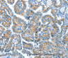 Immunohistochemistry of paraffin-embedded Human thyroid cancer tissue using COG1 Polyclonal Antibody at dilution 1:60