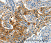 Immunohistochemistry of paraffin-embedded Human lung cancer tissue using COG1 Polyclonal Antibody at dilution 1:60