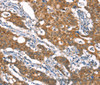 Immunohistochemistry of paraffin-embedded Human gasrtic cancer tissue using CYLD Polyclonal Antibody at dilution 1:35
