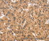 Immunohistochemistry of paraffin-embedded Human liver cancer tissue using DAP Polyclonal Antibody at dilution 1:40