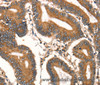 Immunohistochemistry of paraffin-embedded Human colon cancer tissue using DAP Polyclonal Antibody at dilution 1:40