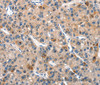 Immunohistochemistry of paraffin-embedded Human liver cancer using DUSP2 Polyclonal Antibody at dilution of 1:30