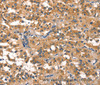 Immunohistochemistry of paraffin-embedded Human thyroid cancer using EIF4G1 Polyclonal Antibody at dilution of 1:30