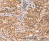 Immunohistochemistry of paraffin-embedded Human gastric cancer using EIF4G1 Polyclonal Antibody at dilution of 1:30
