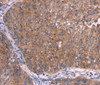 Immunohistochemistry of paraffin-embedded Human ovarian cancer tissue using EMP2 Polyclonal Antibody at dilution 1:30