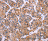 Immunohistochemistry of paraffin-embedded Human liver cancer tissue using MSMO1 Polyclonal Antibody at dilution 1:40