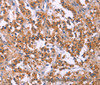 Immunohistochemistry of paraffin-embedded Human thyroid cancer tissue using MSMO1 Polyclonal Antibody at dilution 1:40