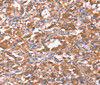 Immunohistochemistry of paraffin-embedded Human thyroid cancer tissue using FAM13B Polyclonal Antibody at dilution 1:30