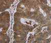 Immunohistochemistry of paraffin-embedded Human colon cancer tissue using FOLH1B Polyclonal Antibody at dilution 1:30