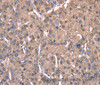 Immunohistochemistry of paraffin-embedded Human liver cancer tissue using SPAST Polyclonal Antibody at dilution 1:40
