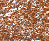 Immunohistochemistry of paraffin-embedded Human thyroid cancer using FUT1 Polyclonal Antibody at dilution of 1:30