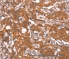 Immunohistochemistry of paraffin-embedded Human gastric cancer using FUT1 Polyclonal Antibody at dilution of 1:30