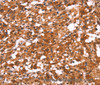 Immunohistochemistry of paraffin-embedded Human thyroid cancer using GABAA Receptor alpha1 Polyclonal Antibody at dilution of 1:30