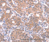 Immunohistochemistry of paraffin-embedded Human gastric cancer using GABAA Receptor alpha1 Polyclonal Antibody at dilution of 1:30