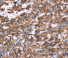 Immunohistochemistry of paraffin-embedded Human thyroid cancer tissue using R3HCC1L Polyclonal Antibody at dilution 1:40