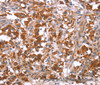 Immunohistochemistry of paraffin-embedded Human thyroid cancer tissue using GLMN Polyclonal Antibody at dilution 1:40