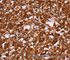 Immunohistochemistry of paraffin-embedded Human thyroid cancer tissue using HIPK1 Polyclonal Antibody at dilution 1:30