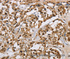 Immunohistochemistry of paraffin-embedded Human thyroid cancer using HNRNP L Polyclonal Antibody at dilution of 1:40