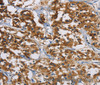 Immunohistochemistry of paraffin-embedded Human thyroid cancer tissue using IGF2R Polyclonal Antibody at dilution 1:40