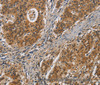 Immunohistochemistry of paraffin-embedded Human gastric cancer tissue using IL17D Polyclonal Antibody at dilution 1:50