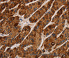 Immunohistochemistry of paraffin-embedded Human liver cancer using IL17RA Polyclonal Antibody at dilution of 1:40