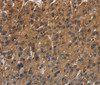 Immunohistochemistry of paraffin-embedded Human gastric cancer using ITGB7 Polyclonal Antibody at dilution of 1:40