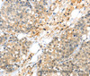 Immunohistochemistry of paraffin-embedded Human liver cancer tissue using KCNG3 Polyclonal Antibody at dilution 1:40