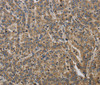Immunohistochemistry of paraffin-embedded Human liver cancer tissue using KCNMB2 Polyclonal Antibody at dilution 1:40