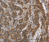 Immunohistochemistry of paraffin-embedded Human liver cancer using KCNQ4 Polyclonal Antibody at dilution of 1:40