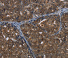 Immunohistochemistry of paraffin-embedded Human ovarian cancer tissue using CERS6 Polyclonal Antibody at dilution 1:35