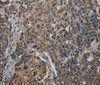 Immunohistochemistry of paraffin-embedded Human cervical cancer using UBP1 Polyclonal Antibody at dilution of 1:40