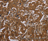Immunohistochemistry of paraffin-embedded Human liver cancer tissue using SCGB1D2 Polyclonal Antibody at dilution 1:40