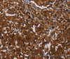 Immunohistochemistry of paraffin-embedded Human liver cancer tissue using MAGEB18 Polyclonal Antibody at dilution 1:30