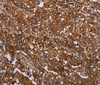 Immunohistochemistry of paraffin-embedded Human liver cancer tissue using MFAP5 Polyclonal Antibody at dilution 1:40
