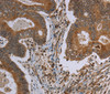 Immunohistochemistry of paraffin-embedded Human colon cancer using MAVS Polyclonal Antibody at dilution of 1:30