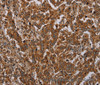 Immunohistochemistry of paraffin-embedded Human liver cancer tissue using ATP2A1 Polyclonal Antibody at dilution 1:30