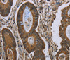 Immunohistochemistry of paraffin-embedded Human colon cancer tissue using NEFH Polyclonal Antibody at dilution 1:40