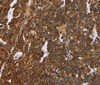 Immunohistochemistry of paraffin-embedded Human ovarian cancer tissue using NEFH Polyclonal Antibody at dilution 1:40